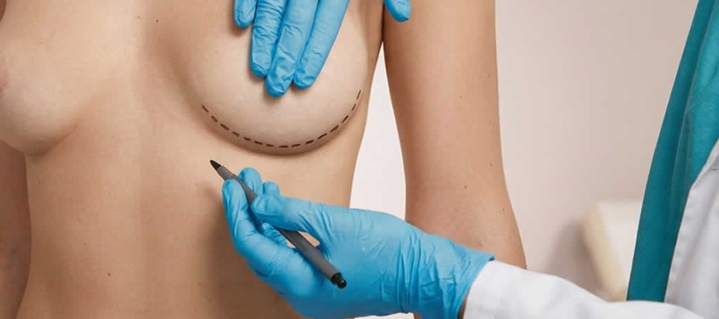 mamoplastia de aumento
