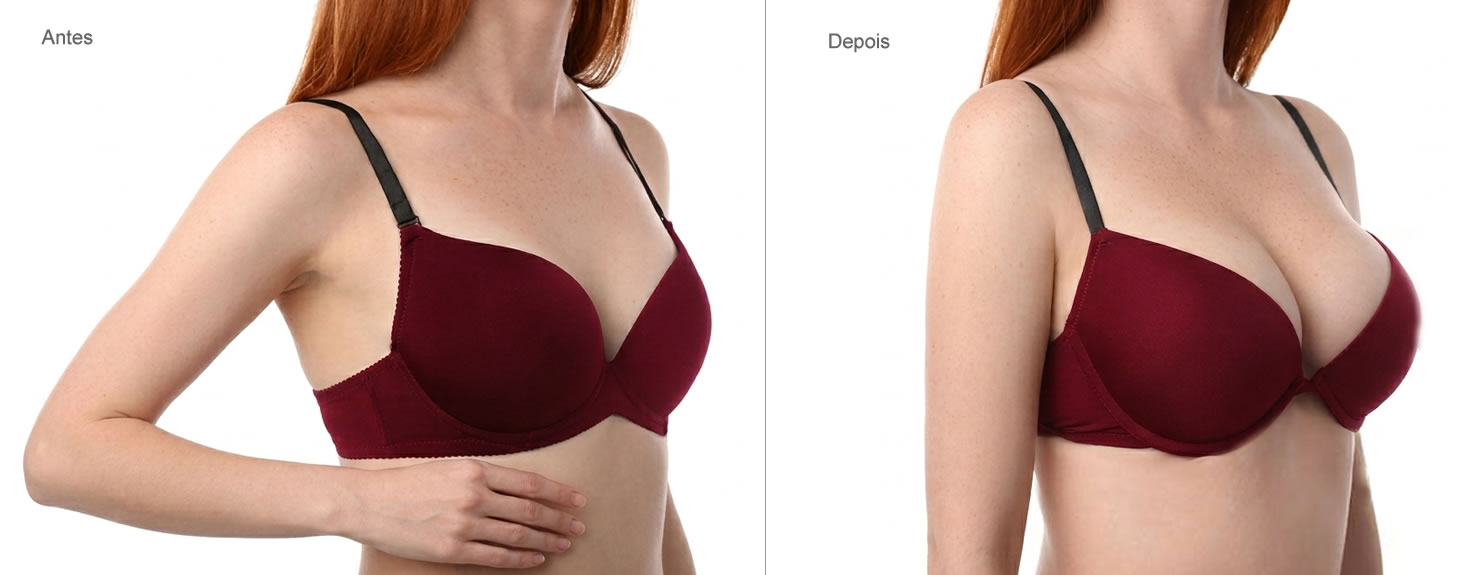 Mamoplastia
